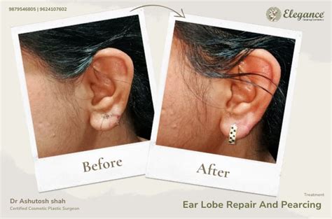 Otoplasty Earlobe Repair Elegance Clinic