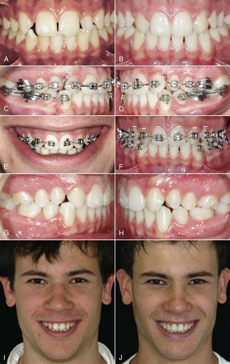 25 Missing Maxillary Lateral Incisors Pocket Dentistry