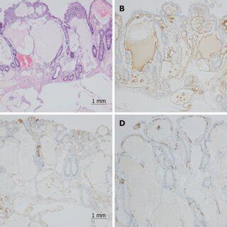 Microscopic Features Of The Resected Tumor A Morphology Showed