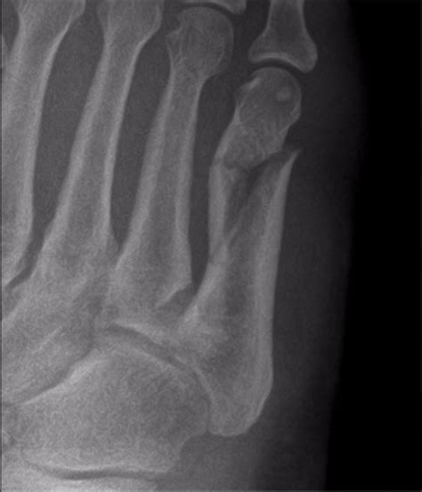 Types Of Fifth Metatarsal Fracture 50 Off