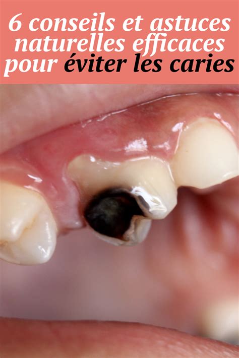 6 conseils et astuces naturelles efficaces pour éviter les caries