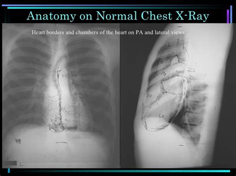Anatomy Of Chest X Ray : Lateral Chest X Ray Anatomy Quotes ...