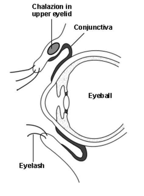 What Is The Difference Between A Chalazion And A Stye Hubpages
