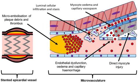 JCM | Free Full-Text | Microvascular Obstruction in Acute Myocardial ... 