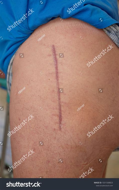 22 Devastated Hip Joint Images Stock Photos And Vectors Shutterstock