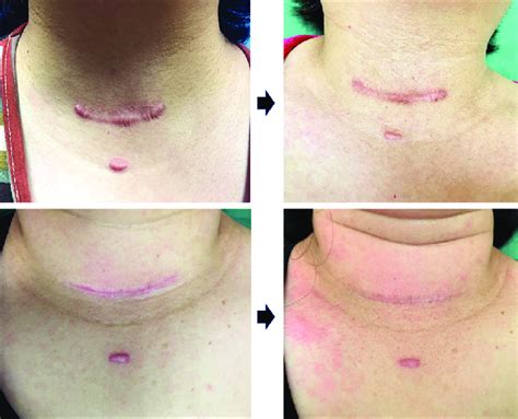 Photographs Of Postthyroidectomy Hypertrophic Scars Of Two Patients