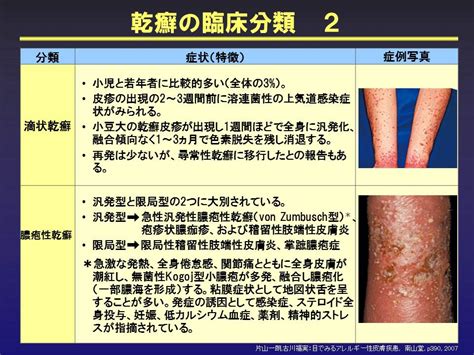 乾癬の症状 治療方法について 渋谷駅前おおしま皮膚科