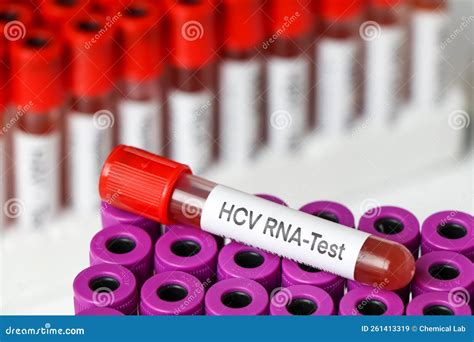 HCV RNA Test To Look for Abnormalities from Blood Stock Image - Image ...