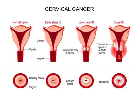 70 Cervical Dysplasia Stock Illustrations Royalty Free Vector