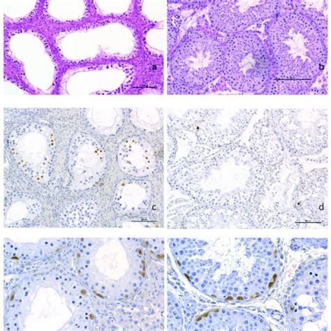 Histopathological Analysis Of Testicular Tissue A Complete Arrest Of