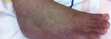 Chikungunya Causes Symptoms Treatment Prevention Complications