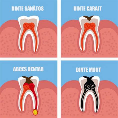 Abcesul Dentar Clinica Stomatologica DENTALINE