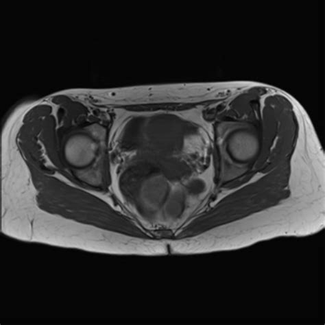 Tailgut Duplication Cyst Image Radiopaedia Org