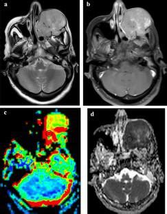 Multi Parametric Arterial Spin Labeling And Diffusion Weighted Imaging