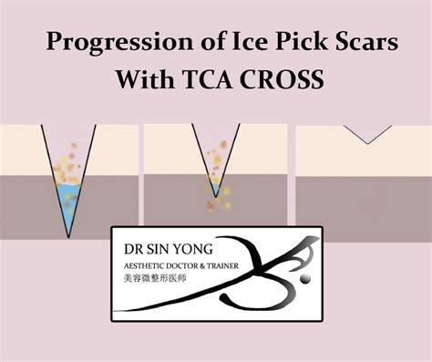 tca cross procedure tca cross keveyd