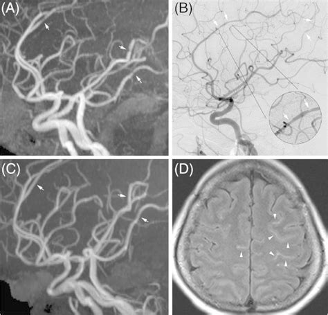 Imaging Findings Of Reversible Cerebral Vasoconstriction Syndrome Download Scientific Diagram