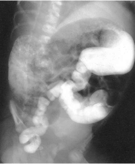 Figure 1 From Surgical Experience With Pull Through Operation In