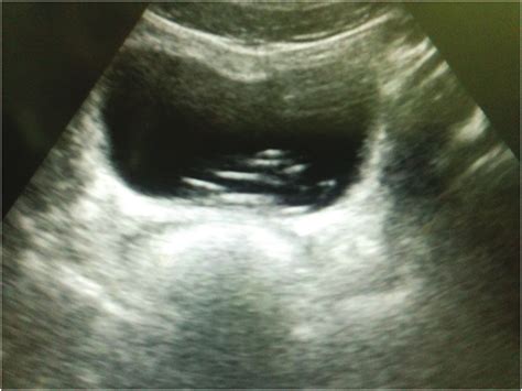 Usg Showing Foreign Body In The Bladder Download Scientific Diagram