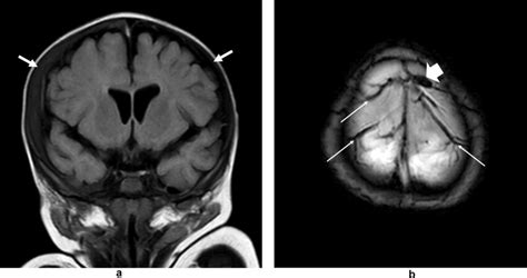 5-month-old boy. Unexplained vomiting and faintness. a Brain MRI, FLAIR ...