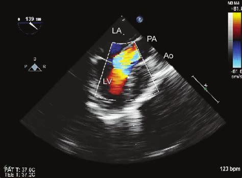 The Modified Bicaval View With Color Flow Doppler Showing The Presence