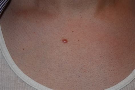 papular-keloid - Keloid Removal Expert - New York