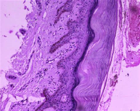 H And E Section Of The Skin Showing Compact Orthohyperkeratosis