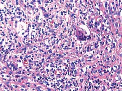 Anatomopathological Examination Of Skin Ulcer Biopsy Showing Infi