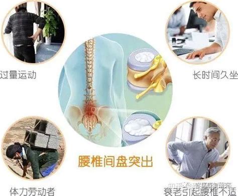 腰椎间盘突出症的相关解剖、诱因、症状、诊断及体格检查和治疗 知乎