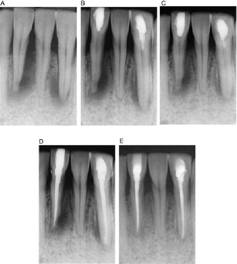 A Apical Periodontitis In Two Lower Incisor Teeth B Four Months Download Scientific