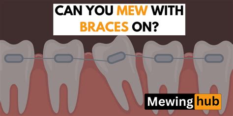 Mewing with Braces, should you do it? – Mewinghub