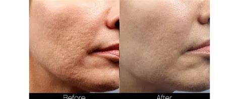 Morpheus8 Skin Treatment In Richmond Va Rf Microneedling