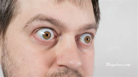 Bulging Eyes Proptosis Causes And Treatment