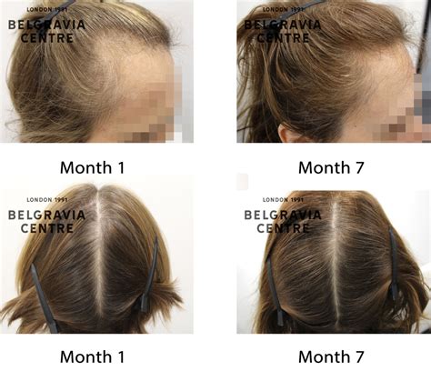 Hair Loss Success Story Im Extremely Happy With My Treatment