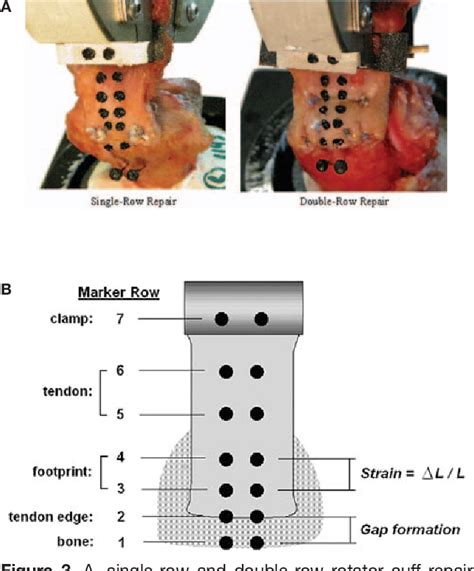 Figure From Biomechanical Comparison Of A Single Row Versus Double