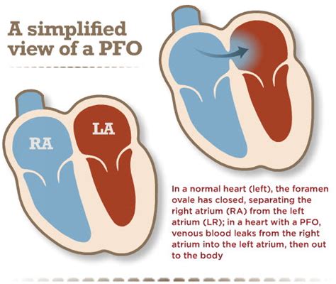 Pfo Patients Guide To Holes In The Heart Myheart