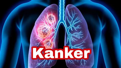 Kanker Youtube