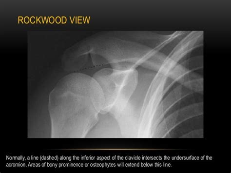 Radiographic Evaluation Of Shoulder