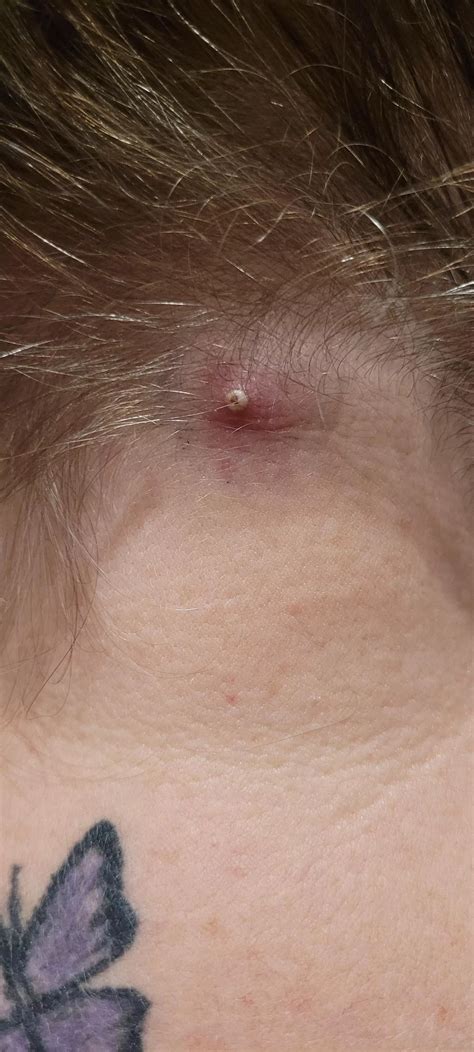 Inflamed Cyst On Nape Of Neck Oc Nudes Popping Nude Pics Org