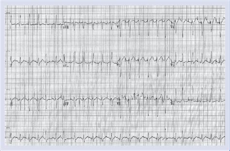 Sequential atrio-ventricular paced rhythm with a rate of 140/min... | Download Scientific Diagram