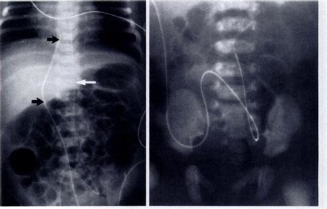 Umbilical Venous Catheter Radiology