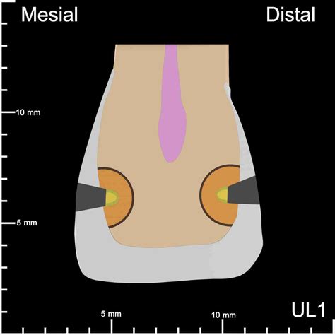 Ul Mesial And Distal Decay K Teeth