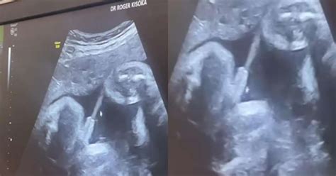 Bebe Faz Muito Xixi - Bebê faz xixi durante ultrassom e vídeo surpreende a web; obstetra explica