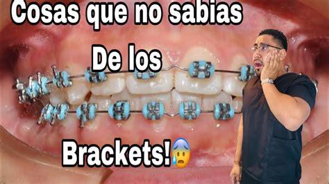 Cosas Que No Sabias De Los Brackets Youtube