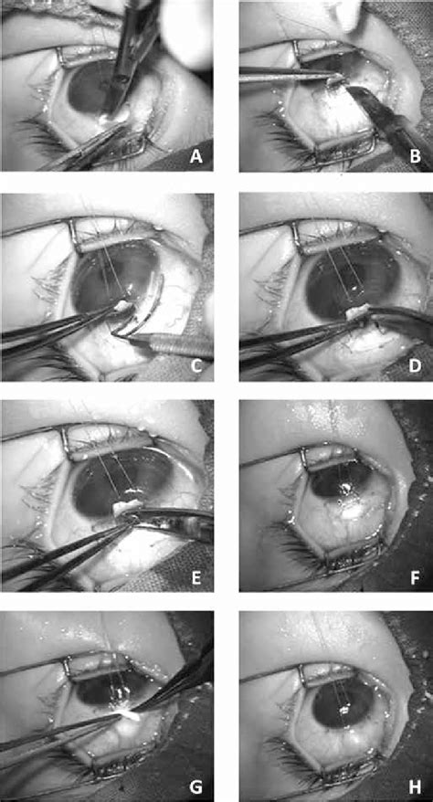 Surgical Technique A Fornix Based Conjunctival Flap B Creation Download Scientific