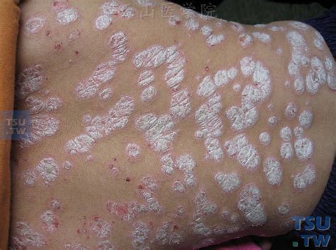 寻常型银屑病Psoriasis Vulgaris的症状表现 皮肤病学 天山医学院