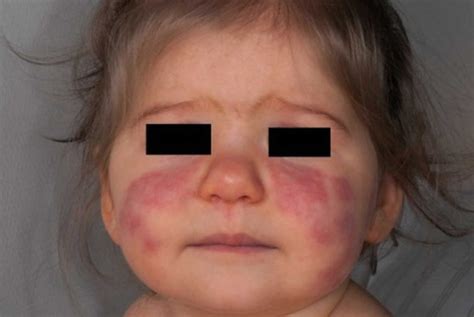 Pediatric Lupus Causes Symptoms Diagnosis Treatment Prognosis