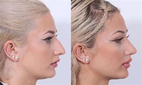 Rhinoplasty Surgical Procedures In West Palm Beach Dr Patrick Cleveland