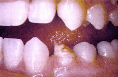 Teeth Abnormalities Flashcards Quizlet