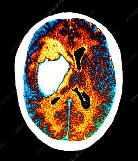 Stroke Brain Ct Scan Stock Image M Science Photo Library