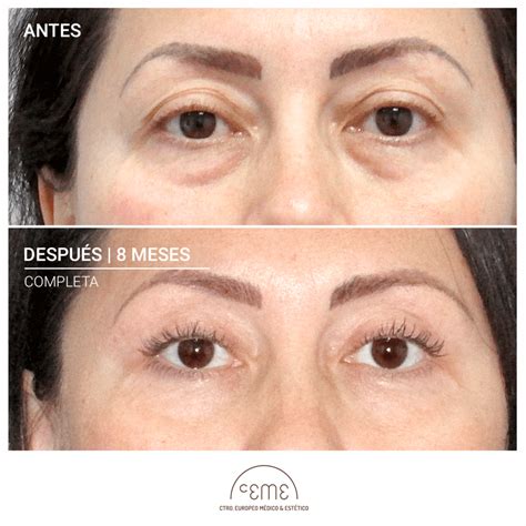 Ceme Blefaroplastia